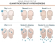 Hyperhidrosis Treatment